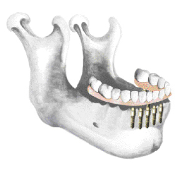 Centre dentaire et implantologie des Moulins à Mascouche - Prothèse inférieure complète Rééquilibre osseux