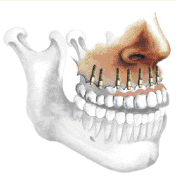 Centre dentaire et implantologie des Moulins à Mascouche - Prothèse supérieure complète